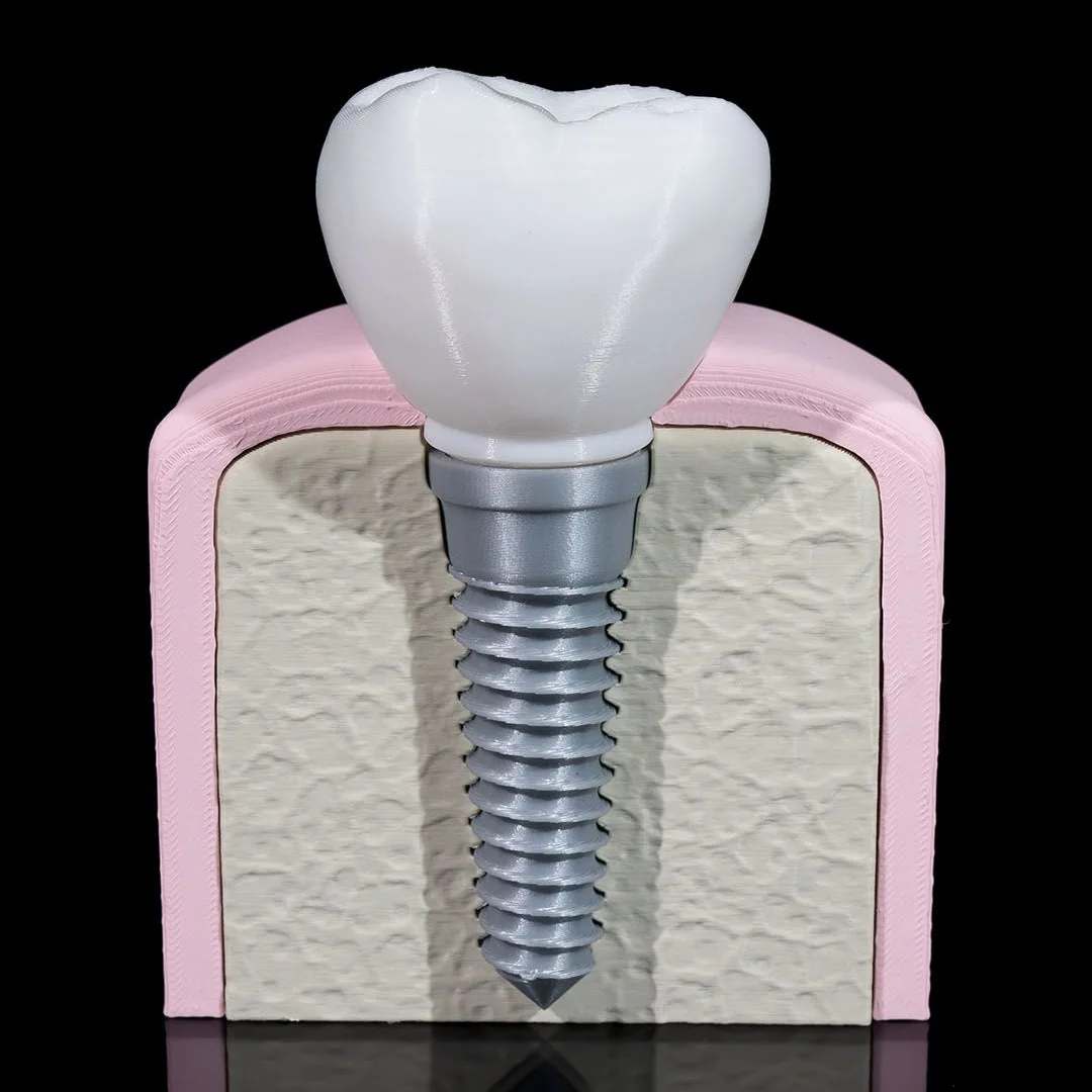 Front view of a dental implant model showing the screw embedded in the jaw section.